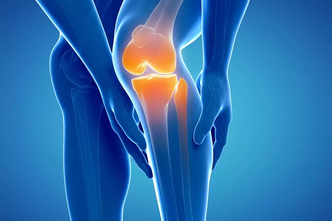 Artrose da articulação do joelho (gonartrose, osteoartrite deformante)