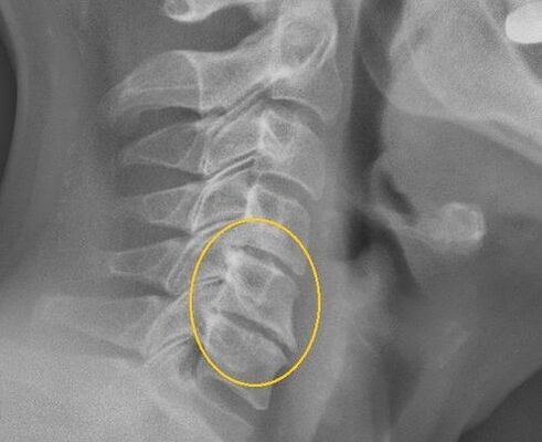 Osteocondrose da coluna cervical em uma raio X