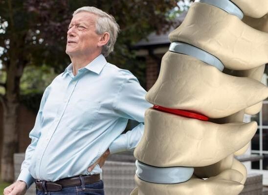 A osteocondrose afeta os discos intervertebrais e causa dores nas costas